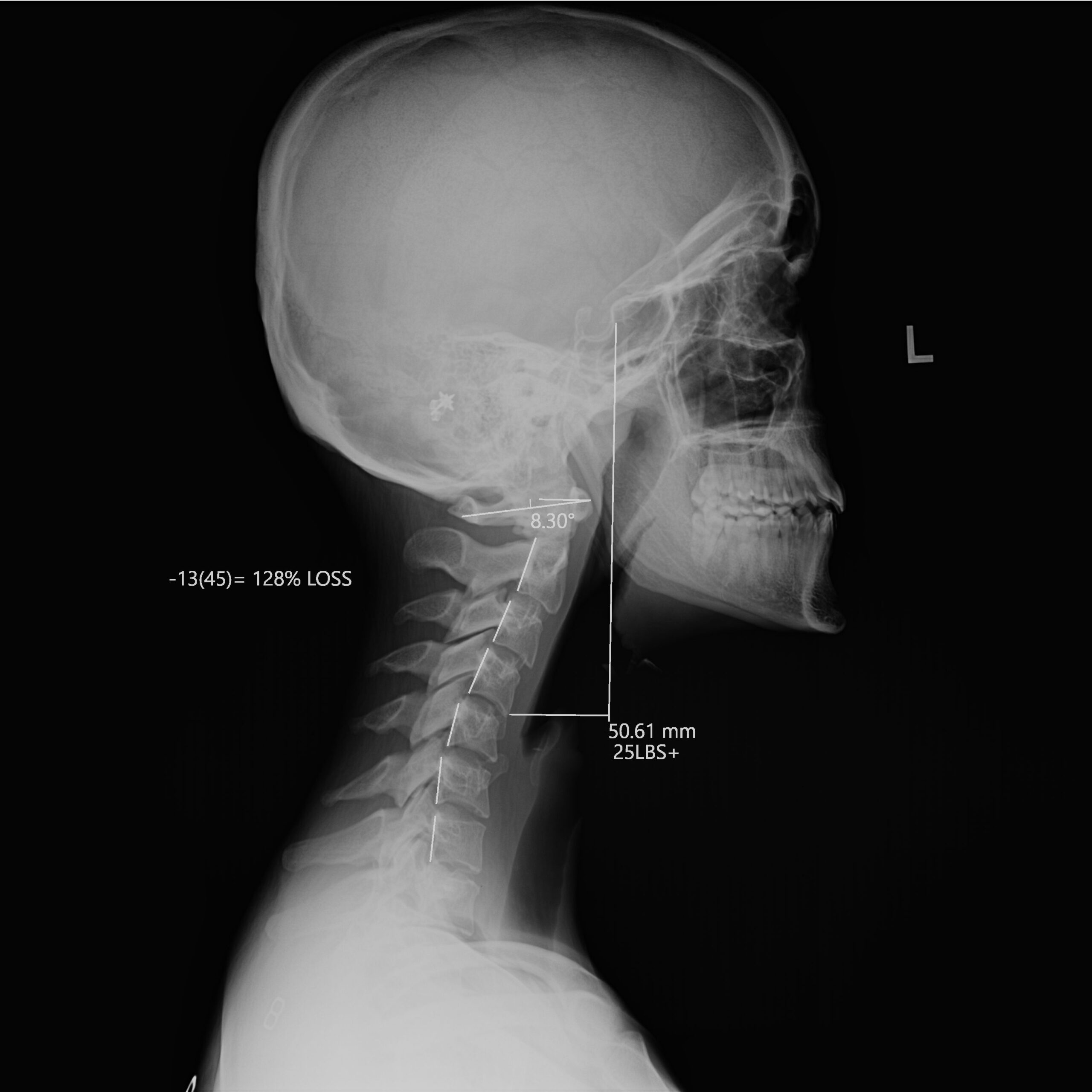 After-Aurora_C Spine_Lateral