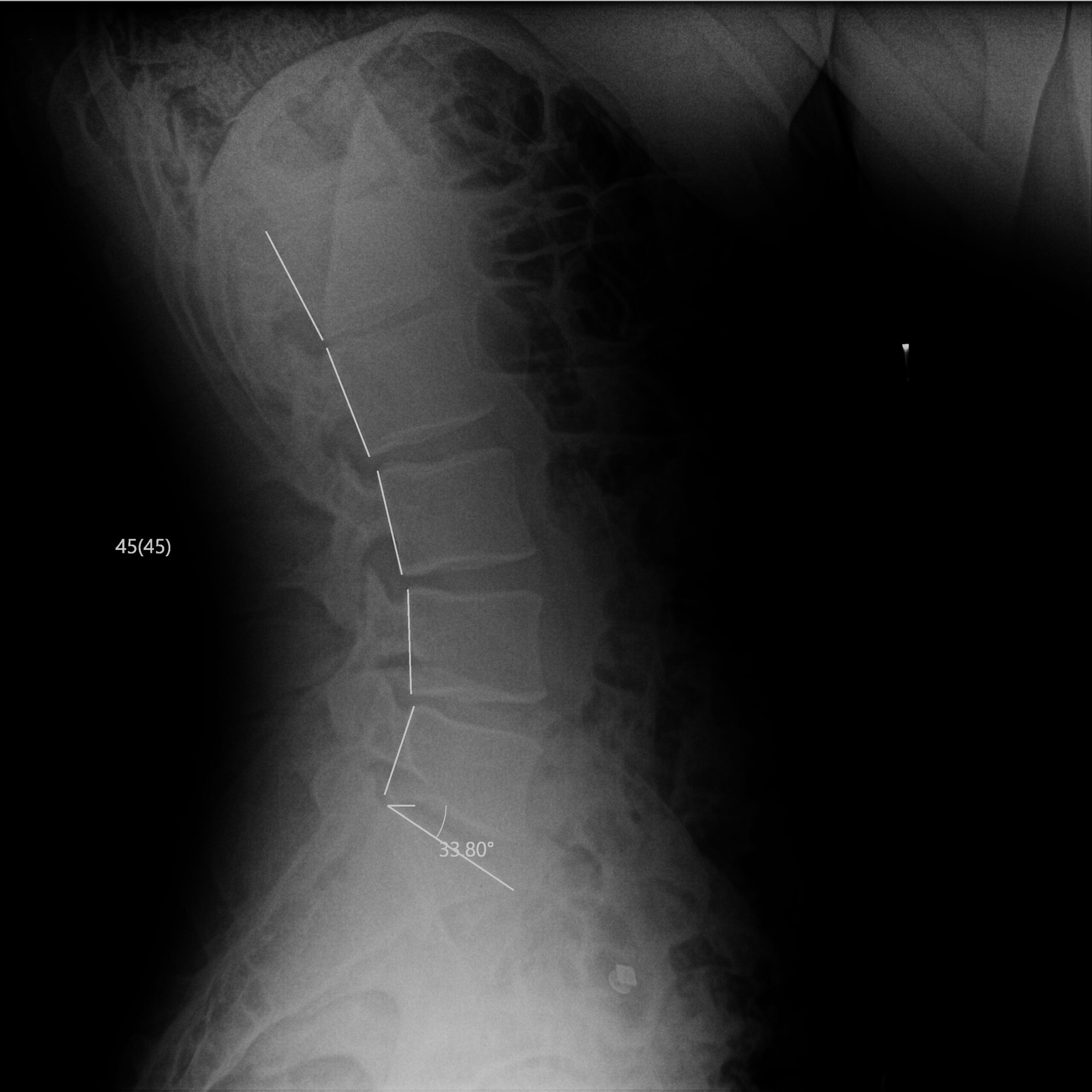 After_Dr Dean Peters LLC_CR_Anderson_Guse_LSpine_Lateral
