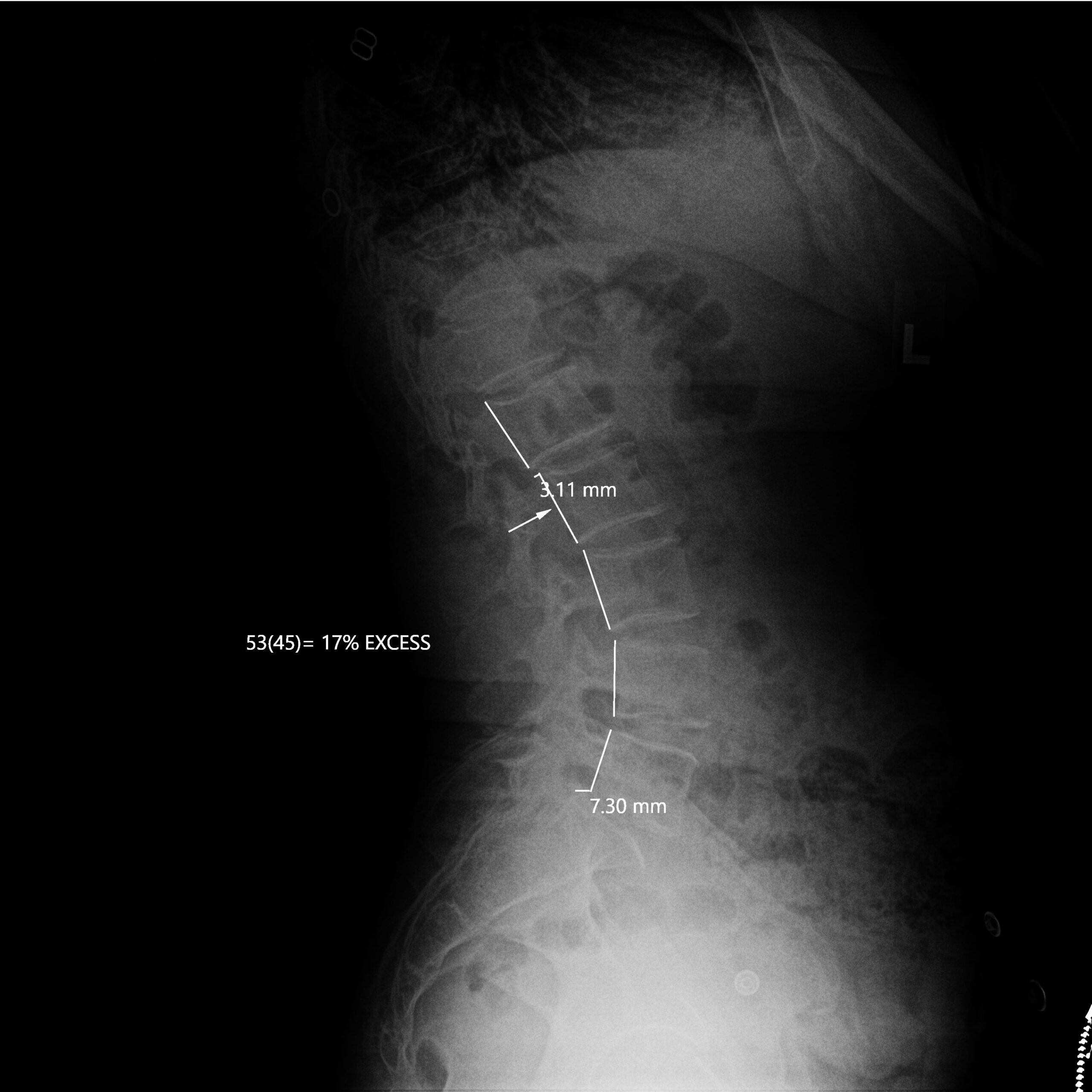 After_Dr Dean Peters LLC_CR_Maria_Acosta_LSpine_Lateral
