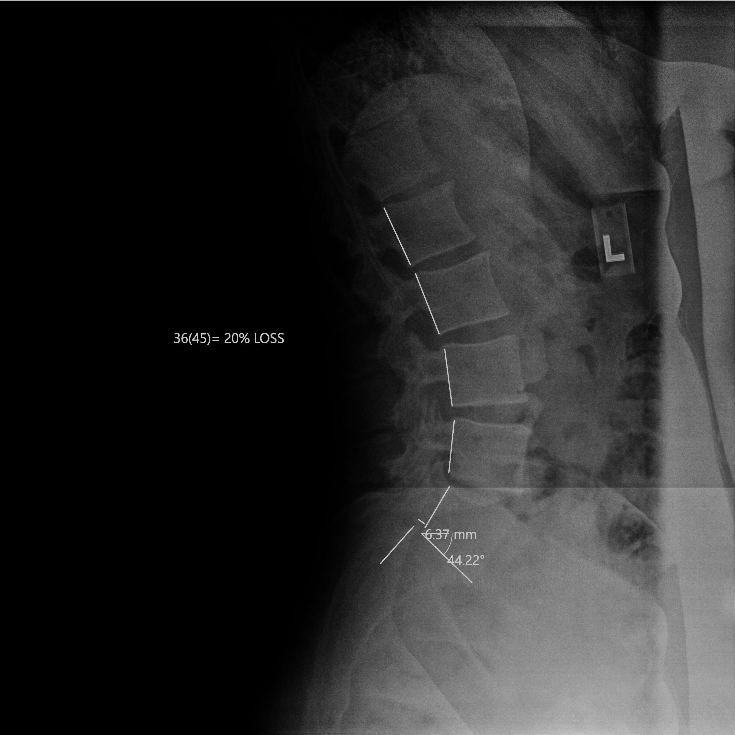 After_Tracey_Bayly_LSpine_Lateral_