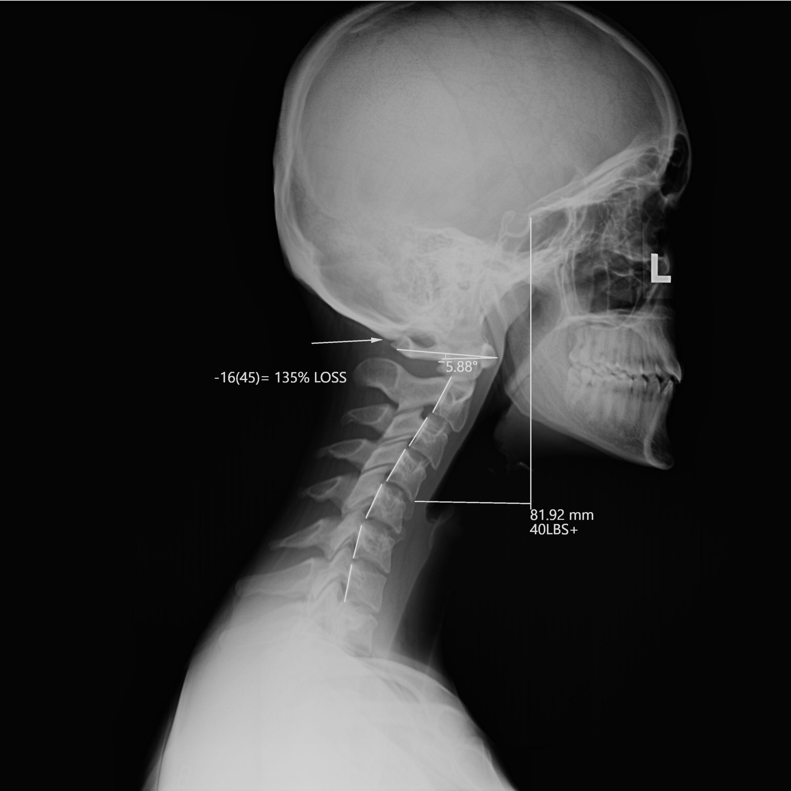 Before-Aurora_Van Pelt_C Spine_Lateral Before-Aurora_Van Pelt_C Spine_Lateral