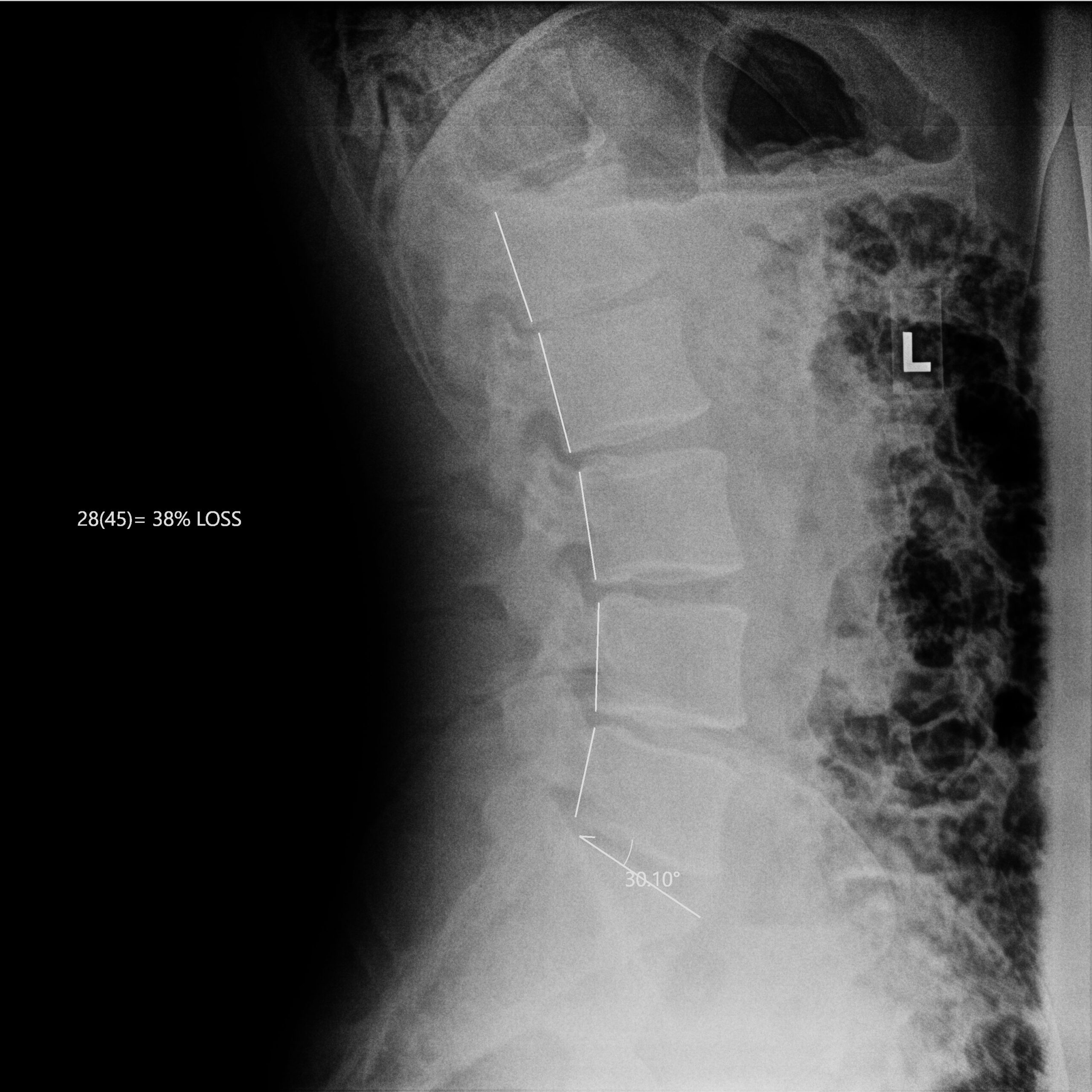 Before_Dr Dean Peters LLC_CR_Anderson_Guse_LSpine Before_Dr Dean Peters LLC_CR_Anderson_Guse_LSpine
