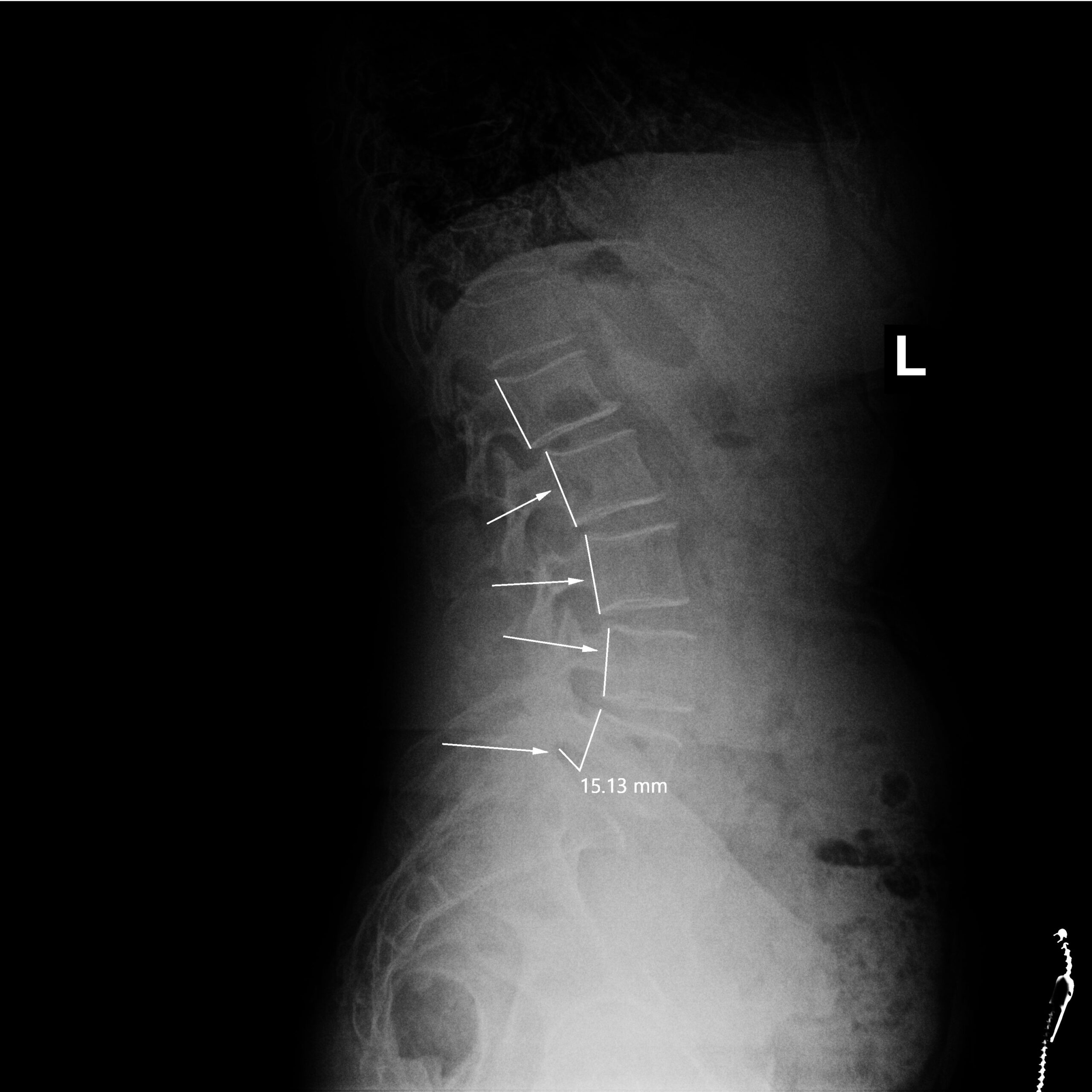 Before_Dr Dean Peters LLC_CR_Maria_Acosta_LSpine_Lateral Before_Dr Dean Peters LLC_CR_Maria_Acosta_LSpine_Lateral
