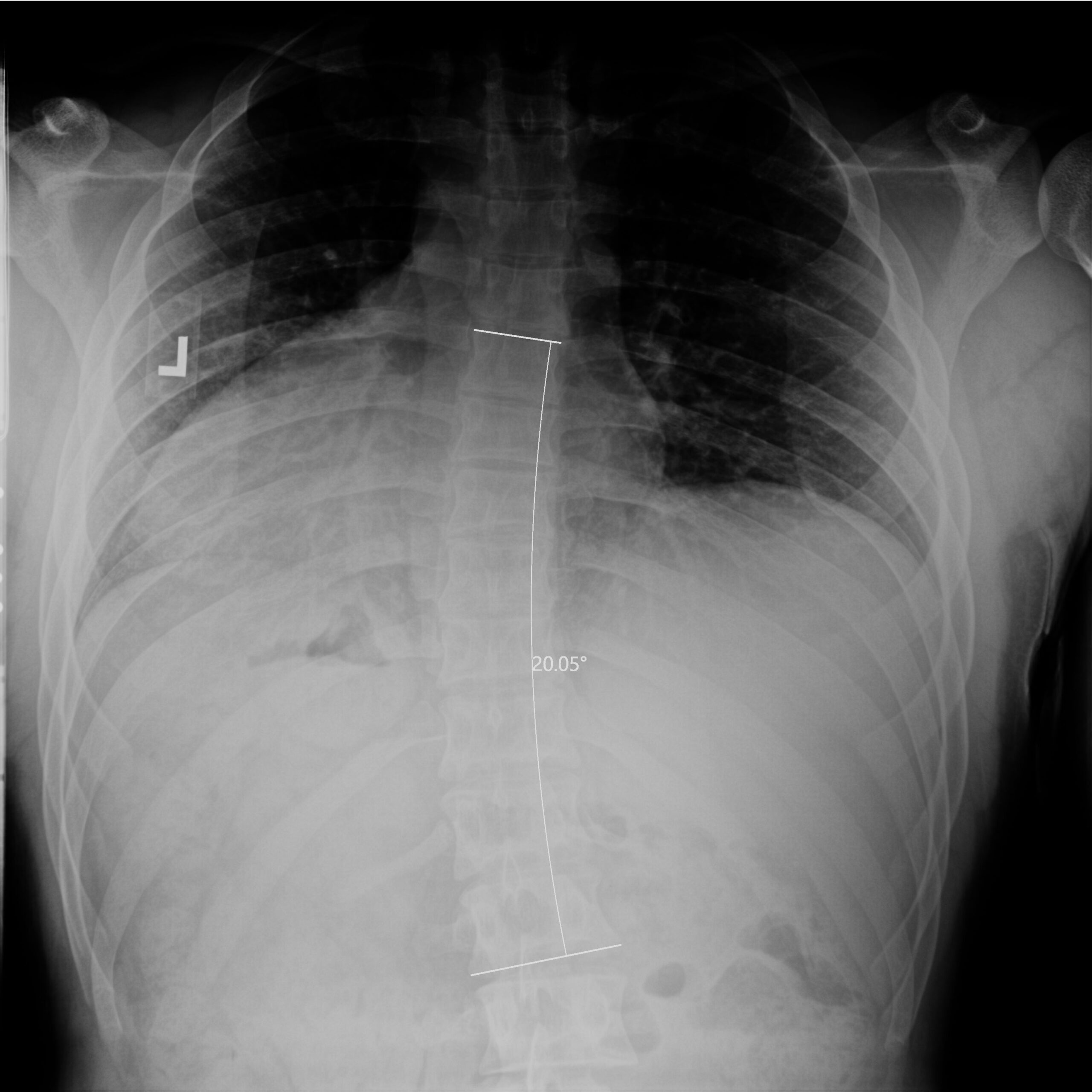 Before_Dr Dean Peters LLC_CR_Thomas_Taranto_TSpine_AP_4-9-2024T6-11-24PM Before_Dr Dean Peters LLC_CR_Thomas_Taranto_TSpine_AP_4-9-2024T6-11-24PM